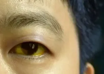 Deep,Jaundice,In,Asian,Male,Patient.,Yellowish,Discoloration,Of,Skin