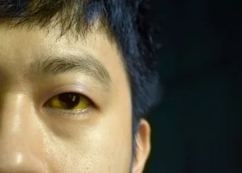 Deep,Jaundice,In,Asian,Male,Patient.,Yellowish,Discoloration,Of,Skin