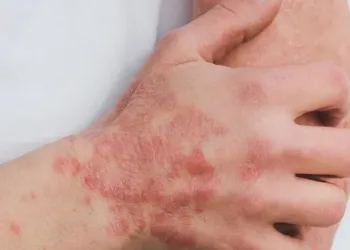 573978-psoriasis-59964241280