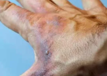 642x361_Burns_Types_Treatments_First_Degree_Dark_Skin