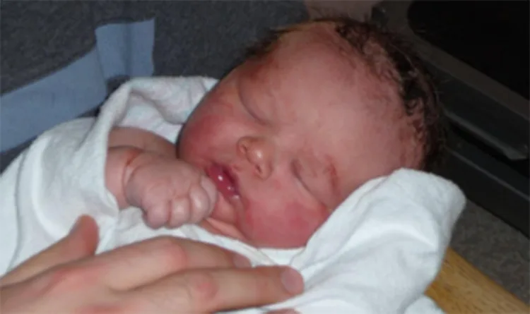 Jaundice in newborns can be serious if not treated on time.