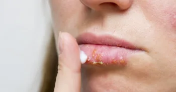 Young woman with cold sore applying cream on lips. Treatment of herpes infection and virus with ointment. Selective focus.