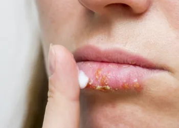 Young woman with cold sore applying cream on lips. Treatment of herpes infection and virus with ointment. Selective focus.