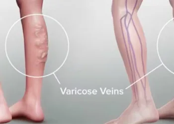 What are varicose veins? How to deal with them?