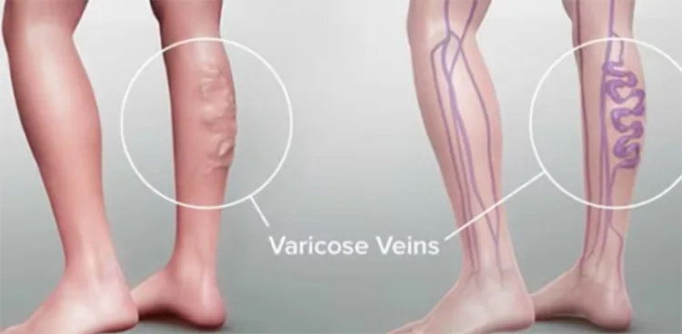 What are varicose veins? How to deal with them?