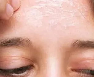 dry-skin-153218257-3x4