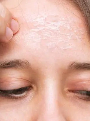 dry-skin-153218257-3x4