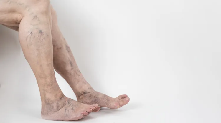 Painful varicose veins and spider veins on active women's legs, helping oneself to overcome pain. Vascular disease, varicose vein problems, White background.